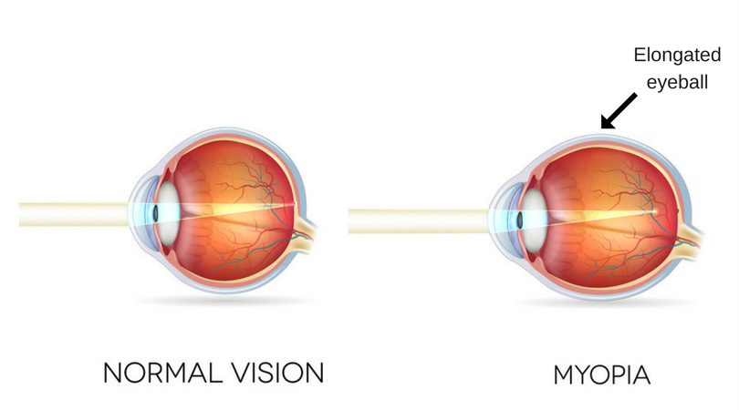 Myopia atau Rabun jauh